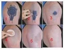 Tattoo Removal Cape Town | tattoo removal cream billy 27735257866 in johannesburg Tattoo Removal Cape Town | tattoo removal cream billy 27735257866 in johannesburg